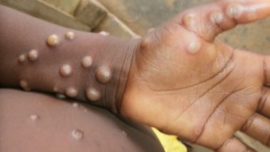 Monkeypox Cases: Sweden Reports First Confirmed Case Amid Outbreak in Europe